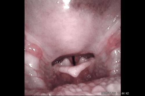 boa relação palato e epiglote