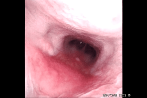 nasofaringe caudal normal